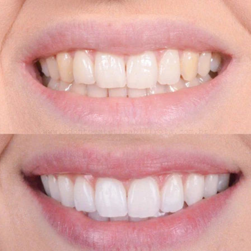SmilePure Zahnaufhellung Gel – Sanfte Teeth Whitening Pflege für Empfindliche Zähne