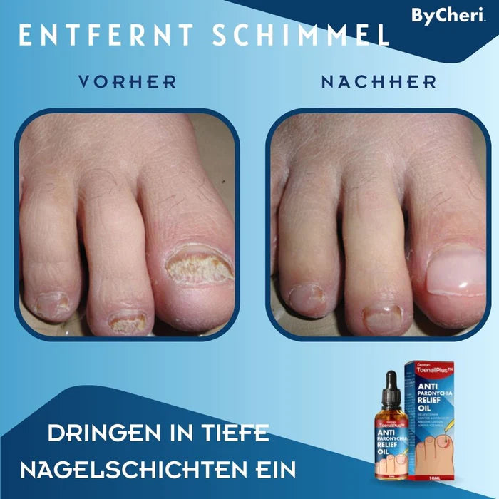 1 + 1 Gratis | ToePerfect™ Anti Paronychia Entlastungsöl