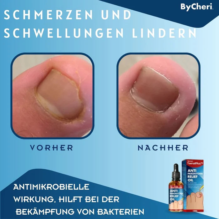 1 + 1 Gratis | ToePerfect™ Anti Paronychia Entlastungsöl