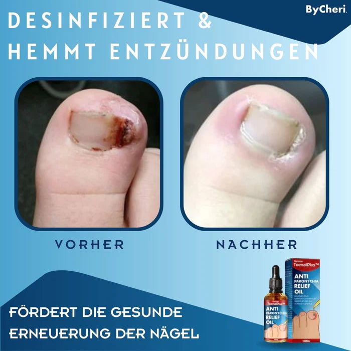 1 + 1 Gratis | ToePerfect™ Anti Paronychia Entlastungsöl