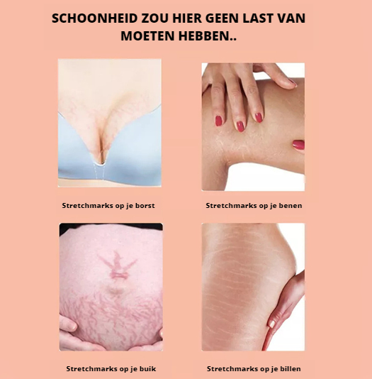 PerfectSkin Dehnungsstreifen-Öl – Natürliche Hautpflege gegen Narben, Striae & trockene Haut