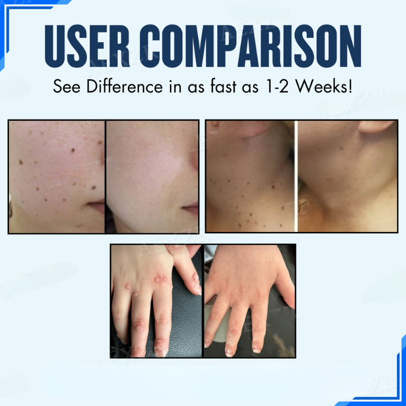 1 + 1 Gratis | ClearSkin™ Effektive Entfernung von Muttermalen und Warzen [Letzter Tag Rabatt]