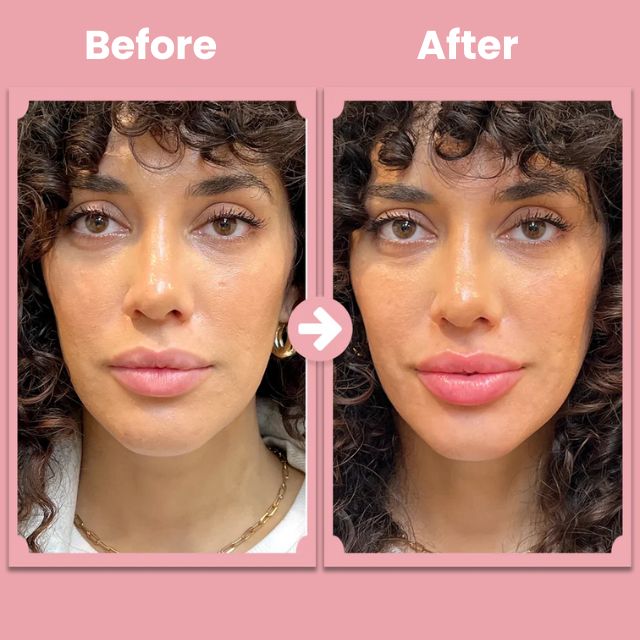 KissBloom™ - Lippenlift-Roller-Kit [1 + 1 Gratis]