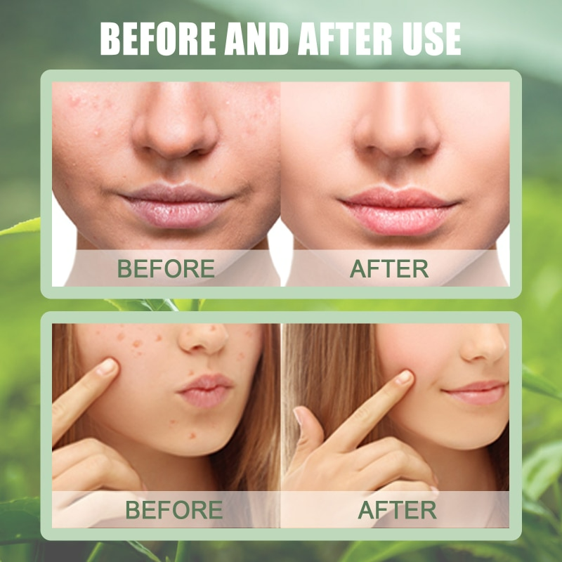 Cleanse & Purify – Mitesser entfernen & Haut porentief reinigen