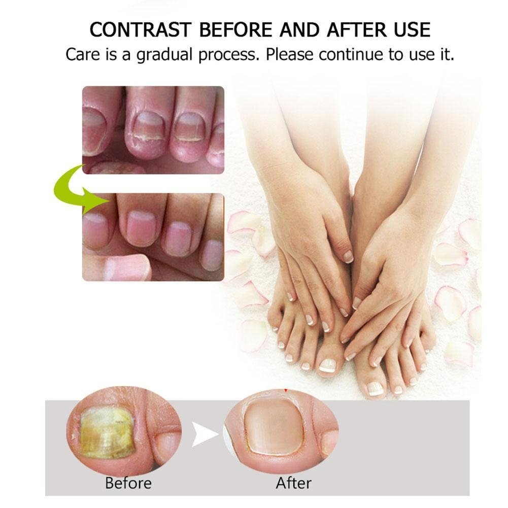 Nail Repair Gel – Nagelpflege, Anti-Pilz, Stärkung, Feuchtigkeit, Gesundes Wachstum