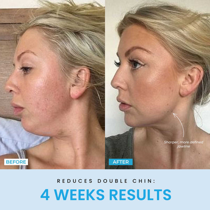ContourVive EMS Gesichtsstraffungsgerät – Kieferlinie, LED-Therapie, Hautlifting, Anti-Aging, Mikrostrom