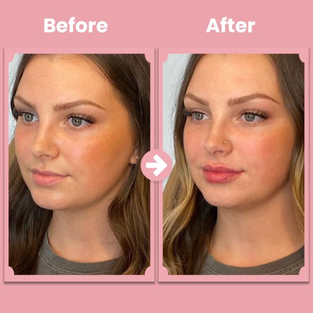 KissBloom™ - Lippenlift-Roller-Kit [1 + 1 Gratis]