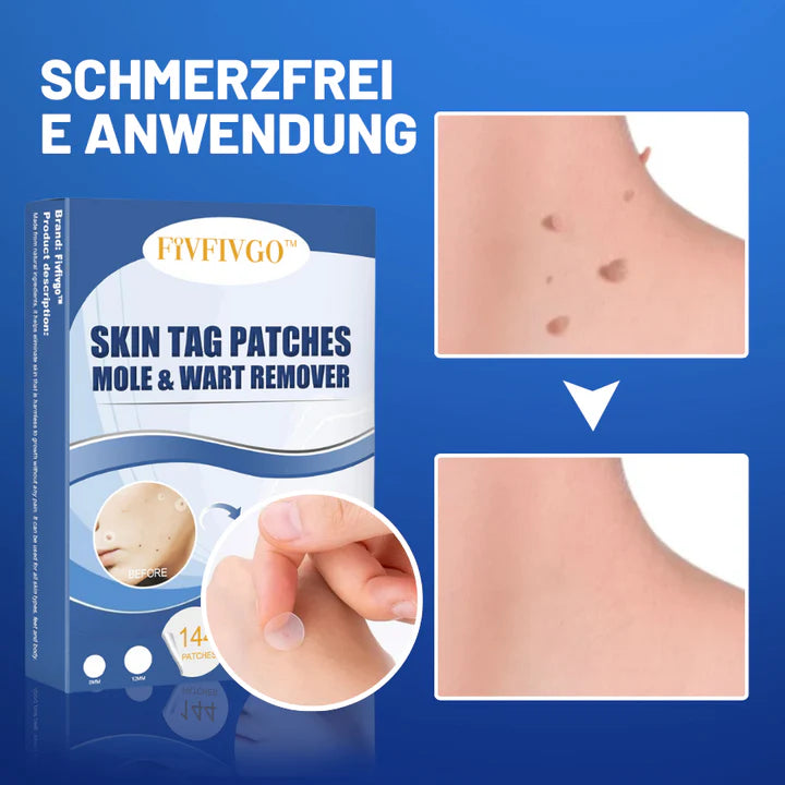 TagAway™ – Pflaster zur Entfernung von Hautanhängern und Warzen | 50% Rabatt