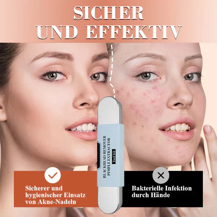 ClearSkin™ – Präzise Mitesserentfernung für glatte, reine & strahlende Haut [50% Rabatt]