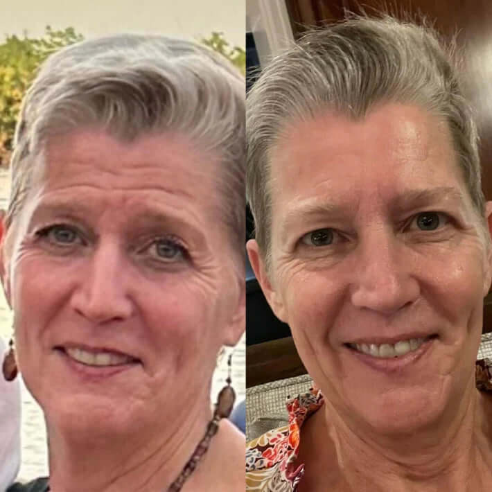 NuSkin™ – Silikon-Faltenpads für Stirn, Augen- und Lachfältchen effektiv [50% Rabatt]