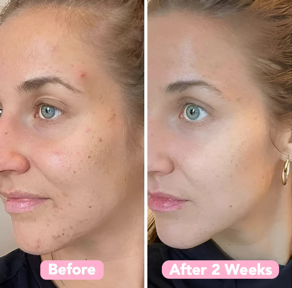 BrightEase™ – Enthülle strahlende, gleichmäßige & makellose Haut, die Blicke auf sich zieht [2 + 2 Gratis]