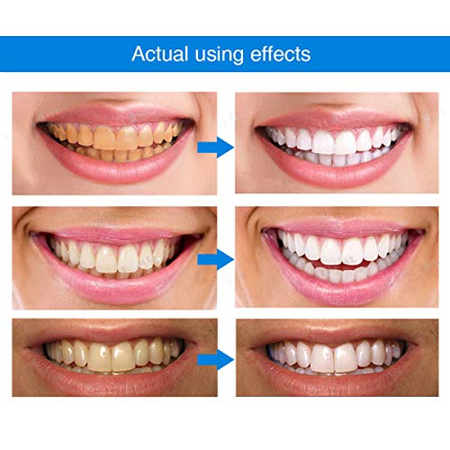 LächelBlitz Zahnaufhellung – Sanfte Teeth Whitening Essenz für Weiße & Gesunde Zähne