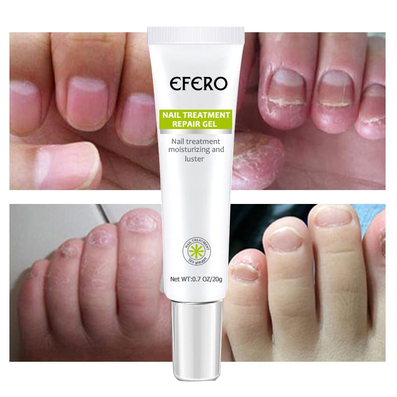 Nail Repair Gel – Nagelpflege, Anti-Pilz, Stärkung, Feuchtigkeit, Gesundes Wachstum