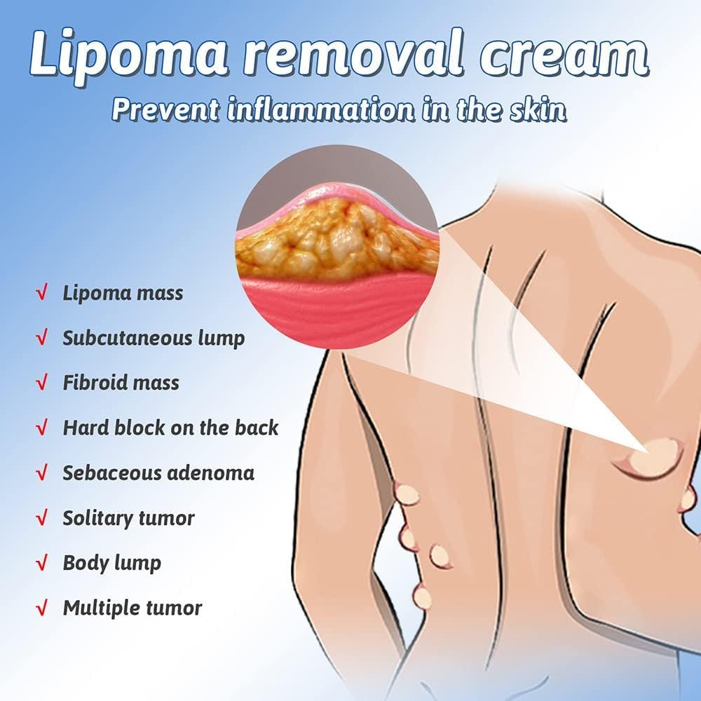 LipoGone Lipom Creme – Schmerzfrei, Natürlich, Entzündungshemmend, Effektiv, Hautpflege