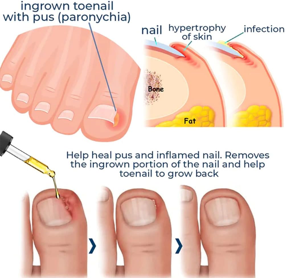 HealDrop™ - Reparatur beschädigter Nägel in 4 Wochen