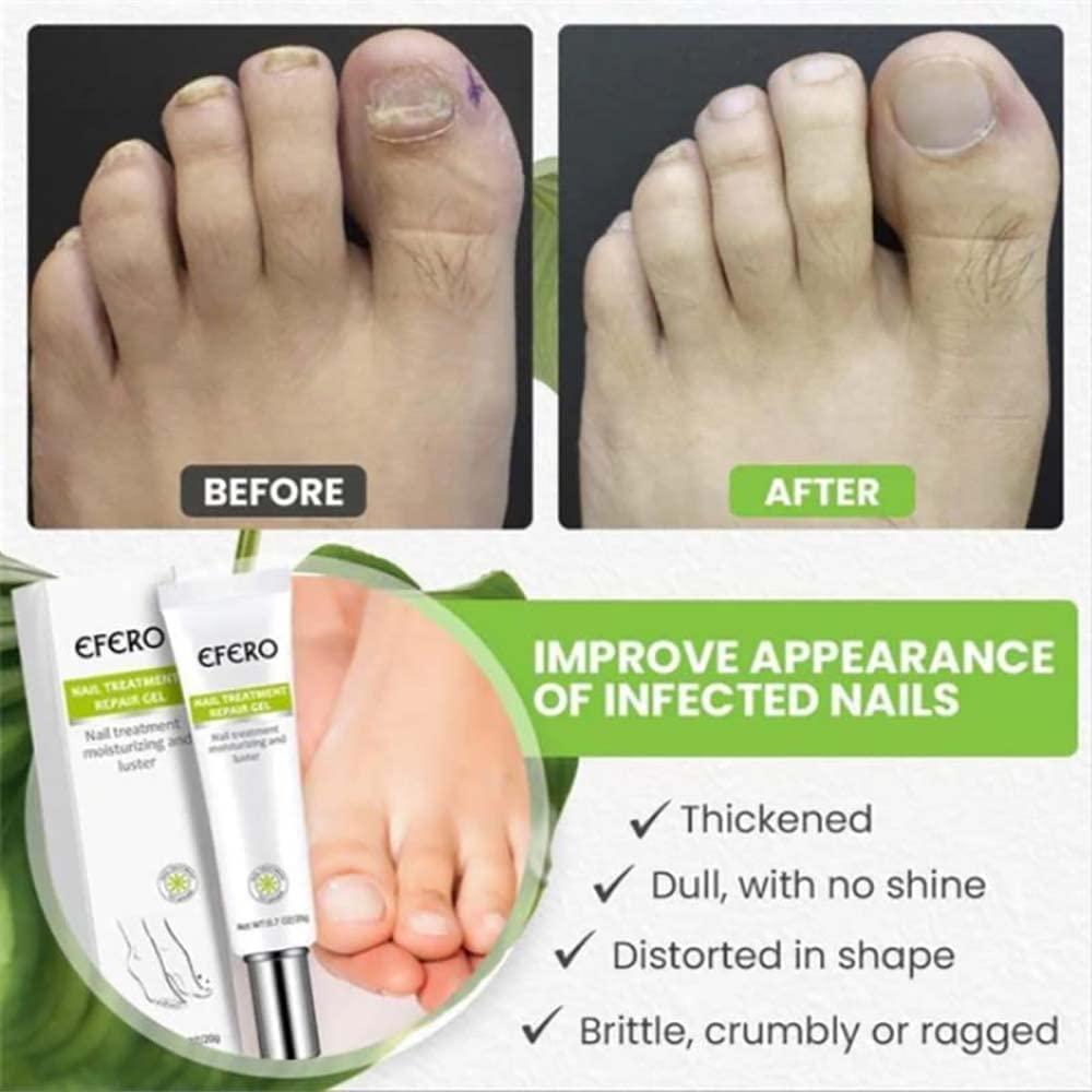 RejuveNail™ – Stärkt deine Nägel für ein gesundes & schönes Aussehen [1 + 1 Gratis]