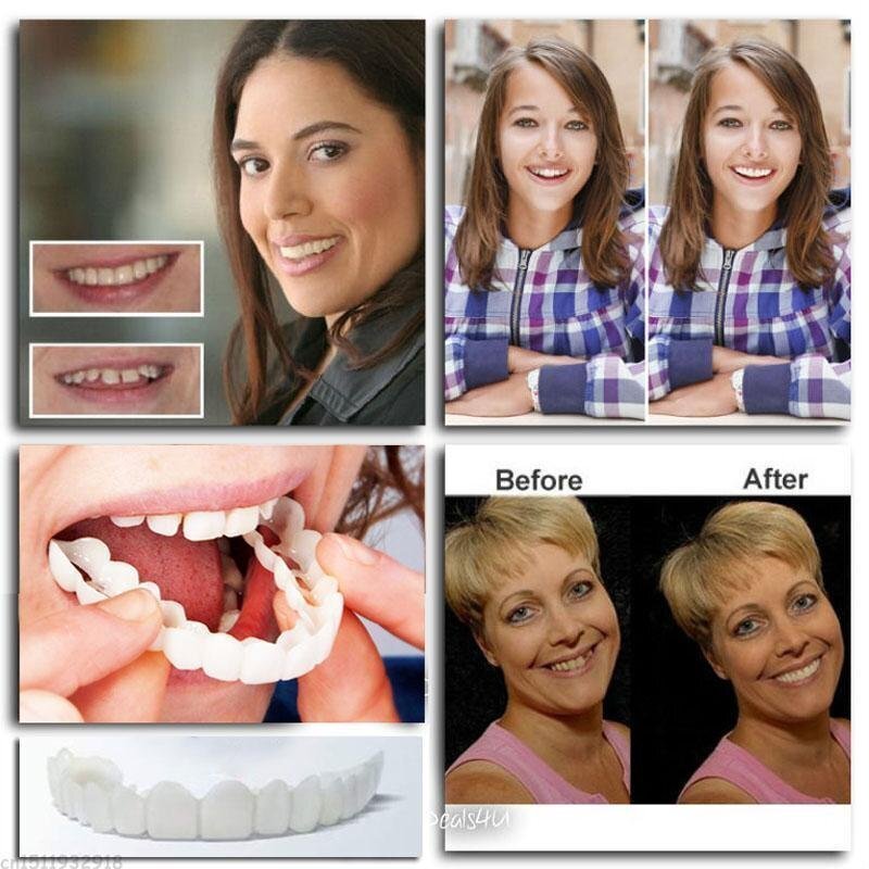 SnapSmile™ – Natürliche, bequeme, langlebige und perfekt sitzende Dentures [50% Rabatt]