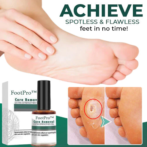 FootPro Hühneraugen Entferner Gel – Schmerzfrei, Schnell, Effektiv, Fußpflege, Hornhaut Entferner