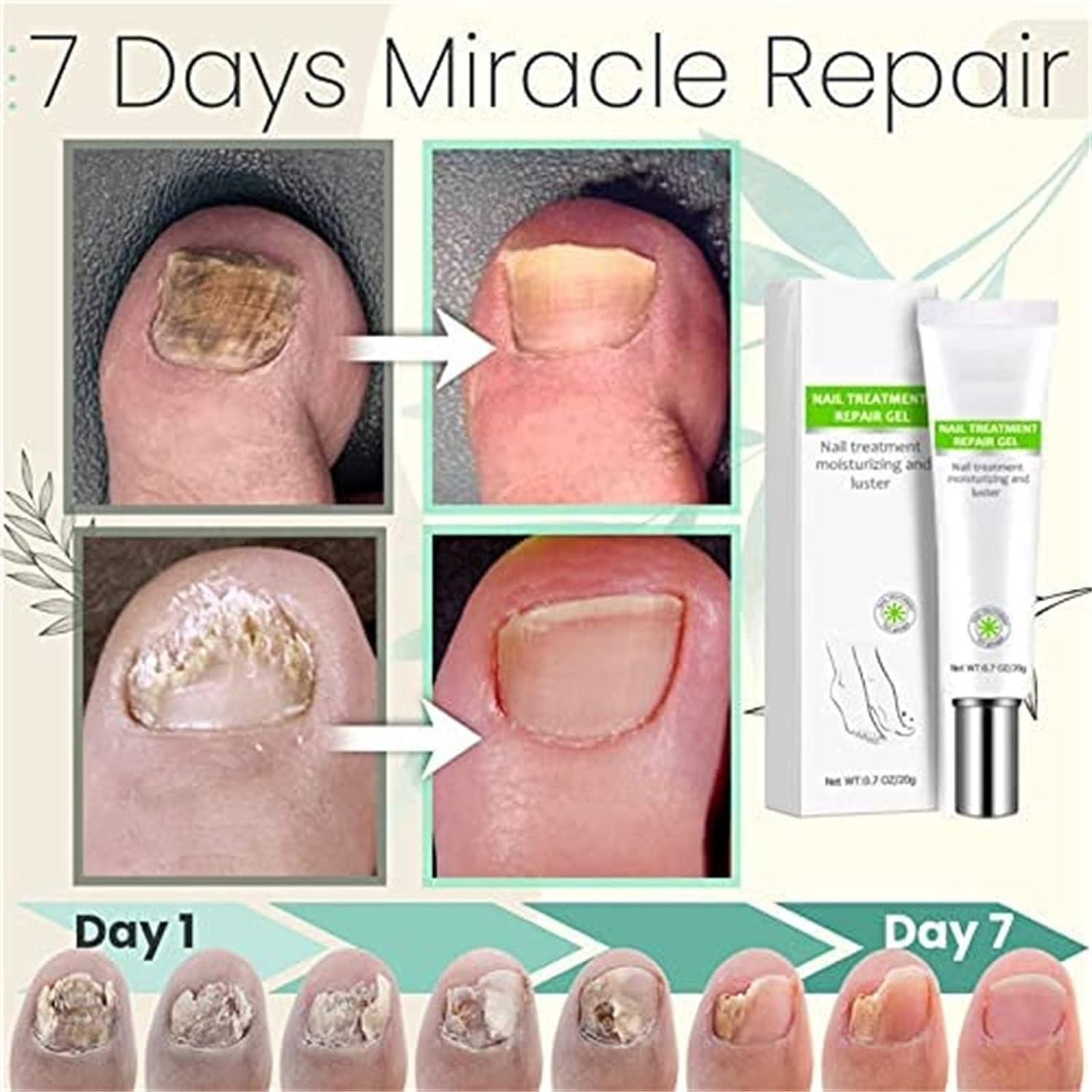 RejuveNail™ – Stärkt deine Nägel für ein gesundes & schönes Aussehen [1 + 1 Gratis]