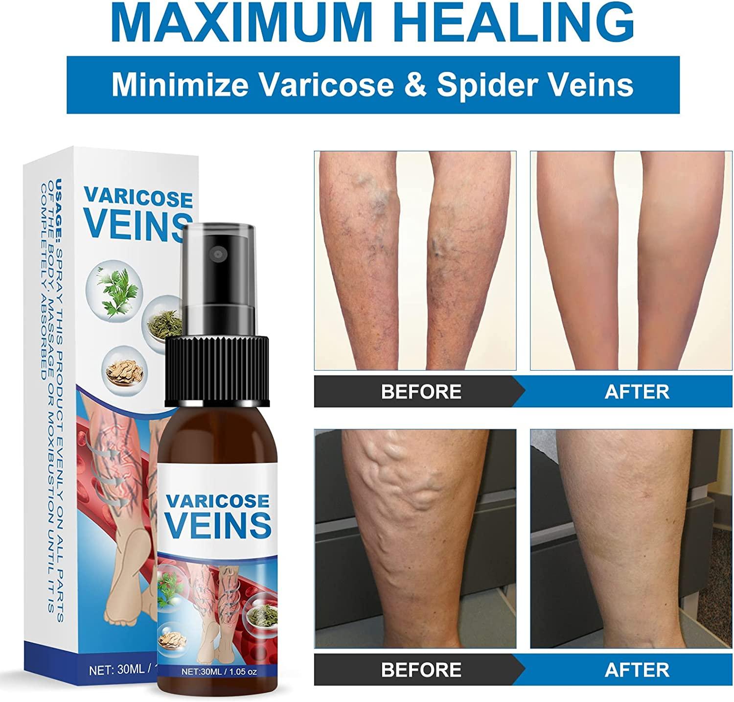 VeinSpray™ - Krampfadern ohne Operation behandeln! [1 + 1 Gratis]