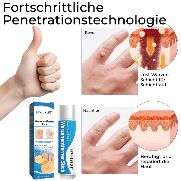 1+1 Gratis | Fivfivgo™ - Schnelle Warzenentfernung