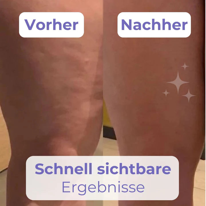 SlimPatch™ Unsichtbare Beinstraffung | 50% Rabatt