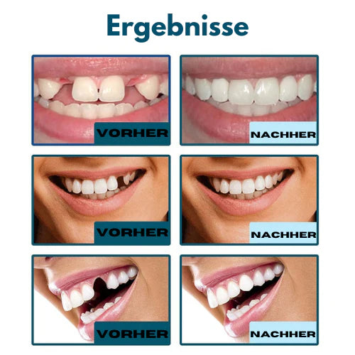 HappySmile™ Zahnspangen-Simulation Zahnersatz | 50% Rabatt