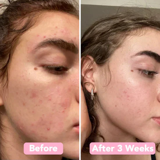 GlowPurify™ – Strahlende Hauterneuerung & tiefenreine Reinigung [50 % Rabatt]