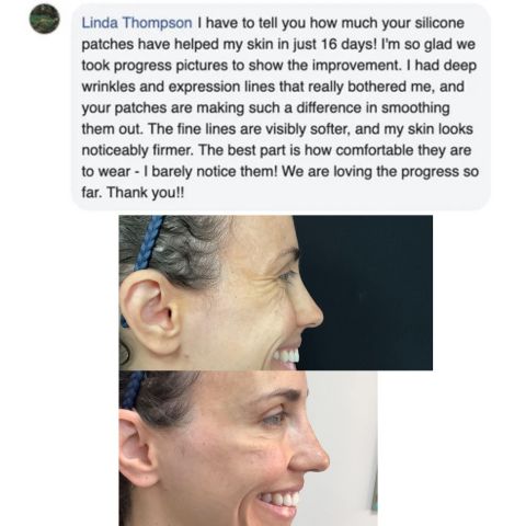 NuSkin™ – Silikon-Faltenpads für Stirn, Augen- und Lachfältchen effektiv [50% Rabatt]