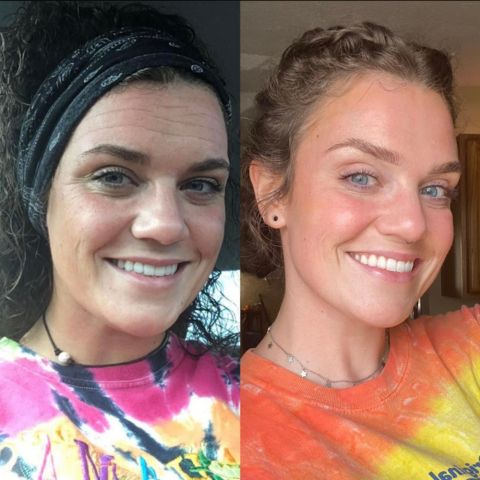 NuSkin™ – Silikon-Faltenpads für Stirn, Augen- und Lachfältchen effektiv [50% Rabatt]