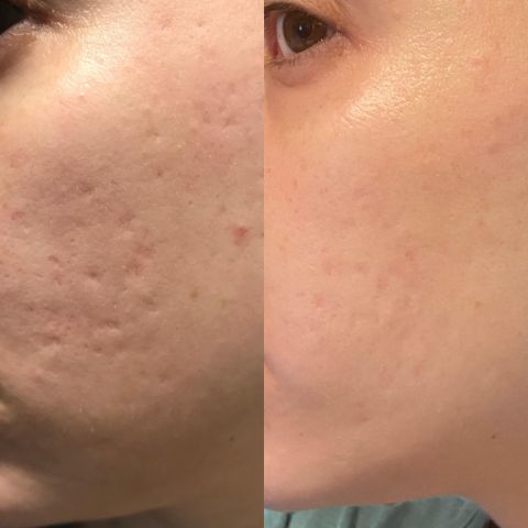 NuSkin™ – Silikon-Faltenpads für Stirn, Augen- und Lachfältchen effektiv [50% Rabatt]