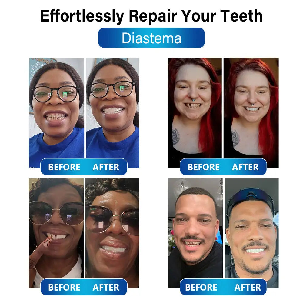 Futusly™ – Professionelle Blaulicht-Härtelampe mit langlebigen Prothesenmaterialien [50% Rabatt]