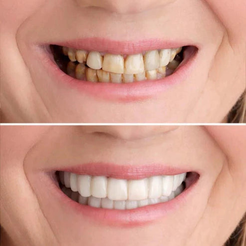 1 + 1 Gratis | SmileFix™ Für das perfekte weiße Lächeln!