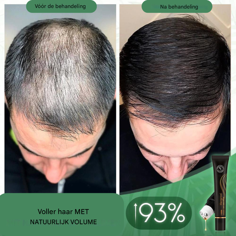 Follicyn™ - Bio-Haarserum Roller [1 + 1 Gratis]
