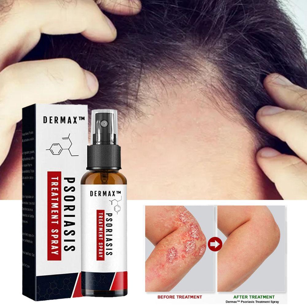 Dermax™ – Effektives Schuppenflechte-Spray für schnelle Hautlinderung [1 + 1 Gratis]