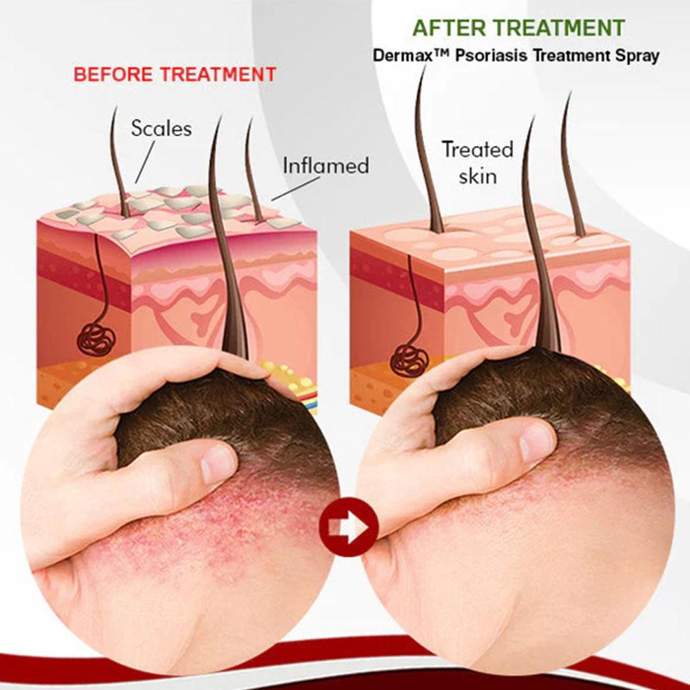 Dermax™ – Effektives Schuppenflechte-Spray für schnelle Hautlinderung [1 + 1 Gratis]