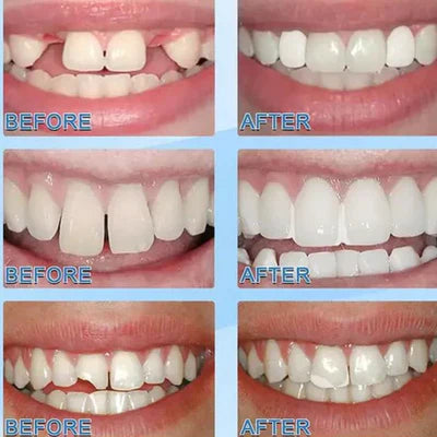 SmilePro™ Wieder mit Selbstvertrauen lächeln | NUR HEUTE 1 + 1 GRATIS