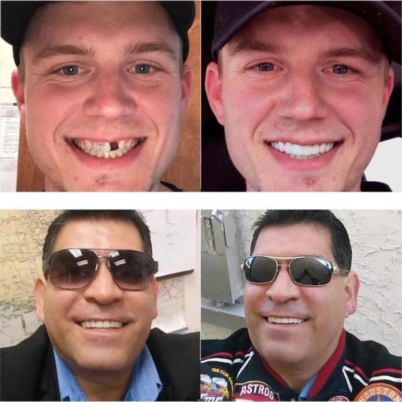 SnapSmile™ – Natürliche, bequeme, langlebige und perfekt sitzende Dentures [50% Rabatt]