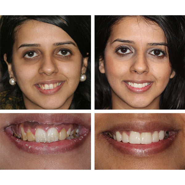 LächelBlitz Zahnaufhellung – Sanfte Teeth Whitening Essenz für Weiße & Gesunde Zähne