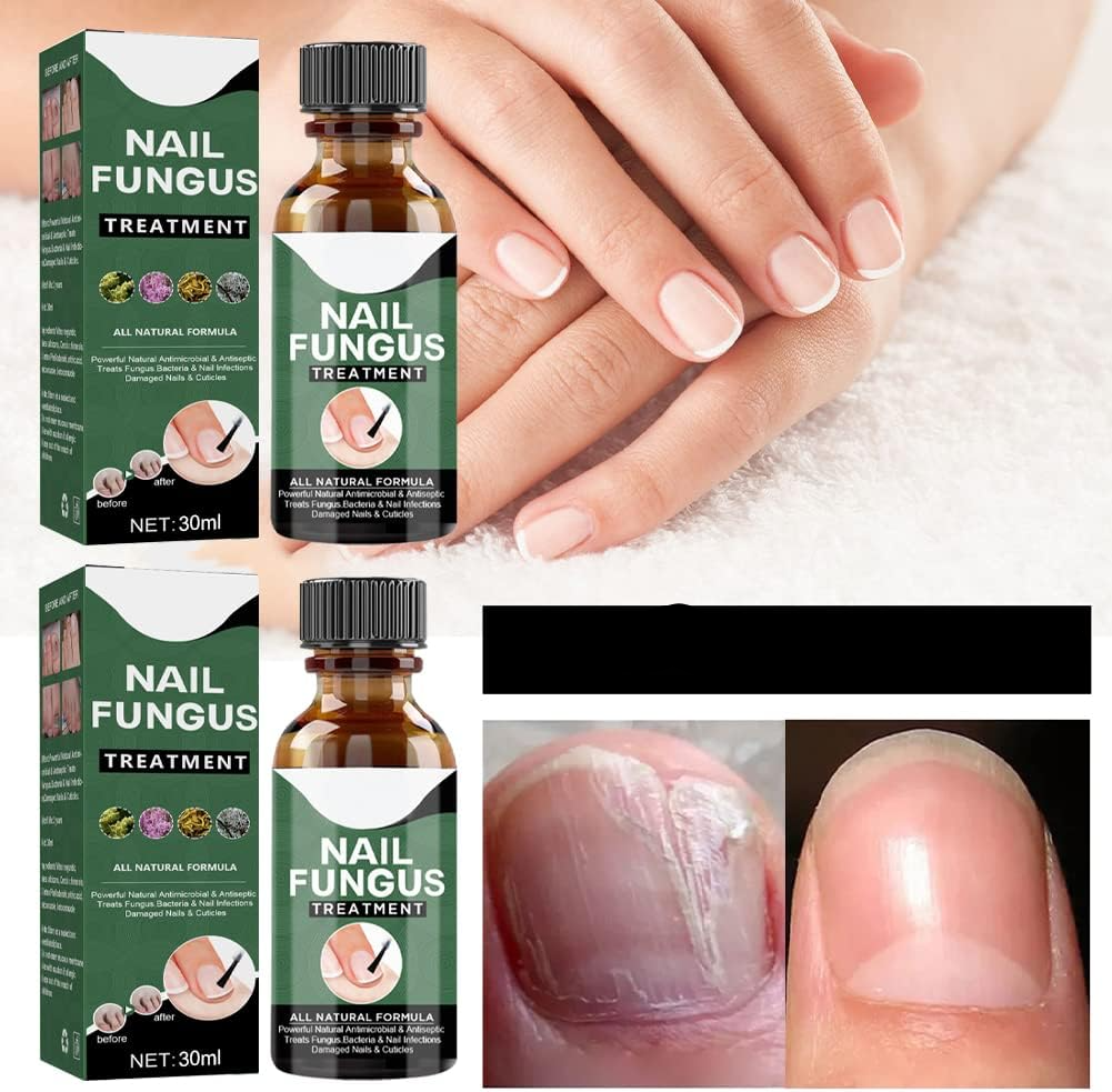 NagelPilz™ – Heilt, restauriert & schützt beschädigte Nägel [50 % Rabatt]