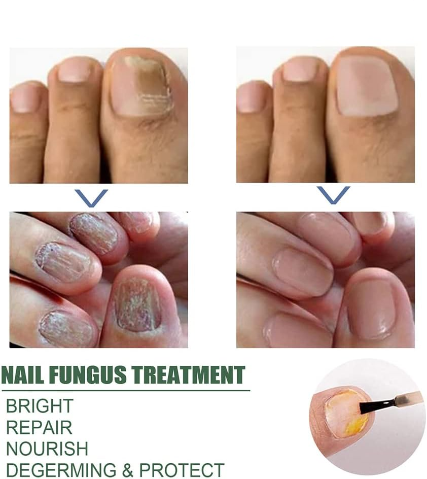 NagelPilz™ – Heilt, regeneriert & schützt geschädigte Nägel [1 + 1 Gratis]