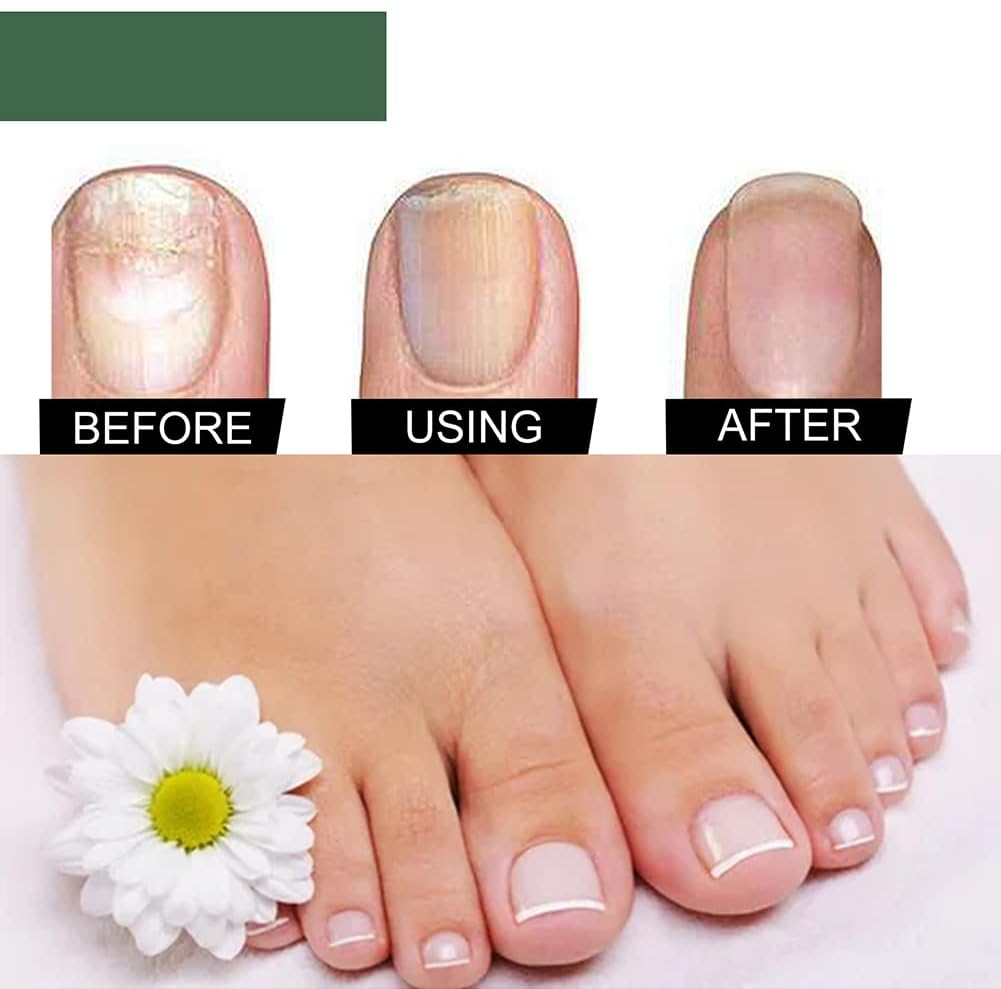 NagelPilz™ – Heilt, restauriert & schützt beschädigte Nägel [50 % Rabatt]