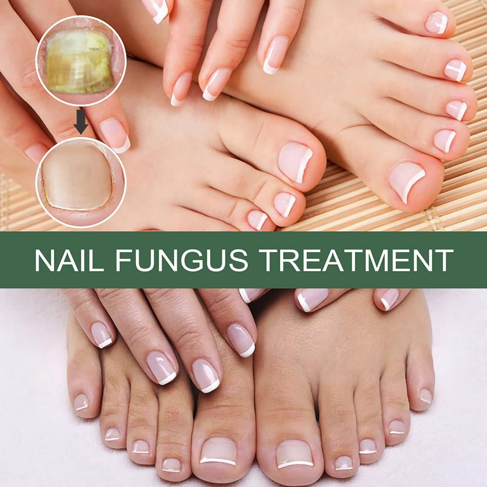 NagelPilz™ – Heilt, restauriert & schützt beschädigte Nägel [50 % Rabatt]