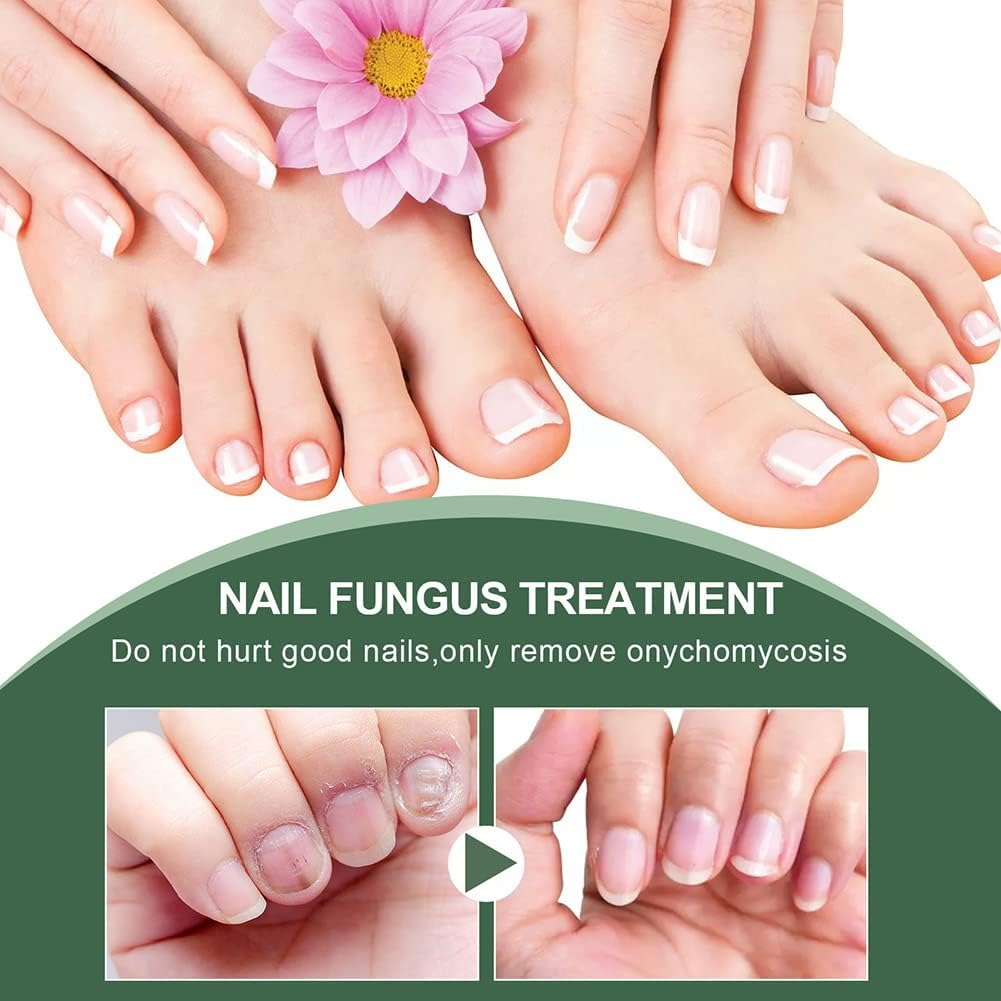 NagelPilz™ – Heilt, restauriert & schützt beschädigte Nägel [50 % Rabatt]