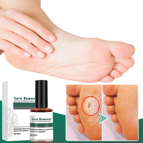 CallusClear™ – Hühneraugen- & Hornhautentferner mit extra starkem Linderungsgel [1 + 1 Gratis]