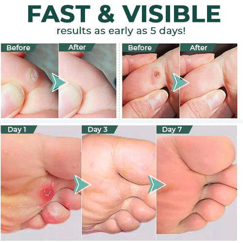 CallusClear™ – Hühneraugen- und Hornhautentferner mit extra starkem Linderungsgel [1 + 1 Gratis]