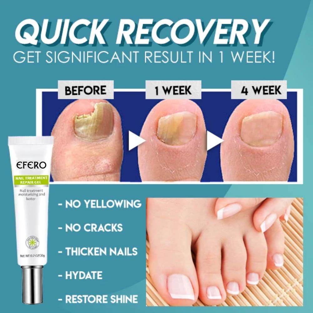 Nail Repair Gel – Nagelpflege, Anti-Pilz, Stärkung, Feuchtigkeit, Gesundes Wachstum