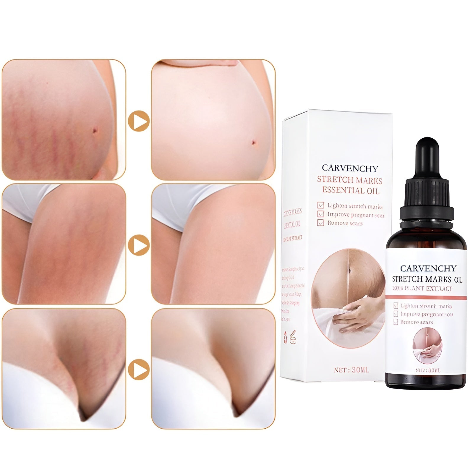 PerfectSkin Dehnungsstreifen-Öl – Natürliche Hautpflege gegen Narben, Striae & trockene Haut