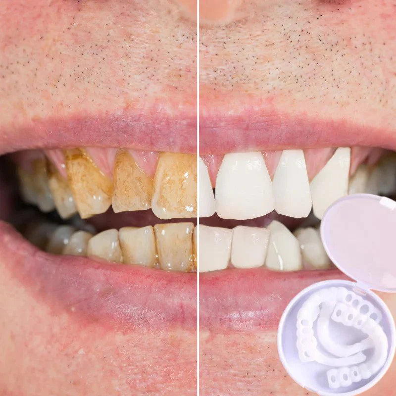 SmileSnap™ – Einrastende Veneers für ein Perfektes Lächeln | 1 + 1 Gratis