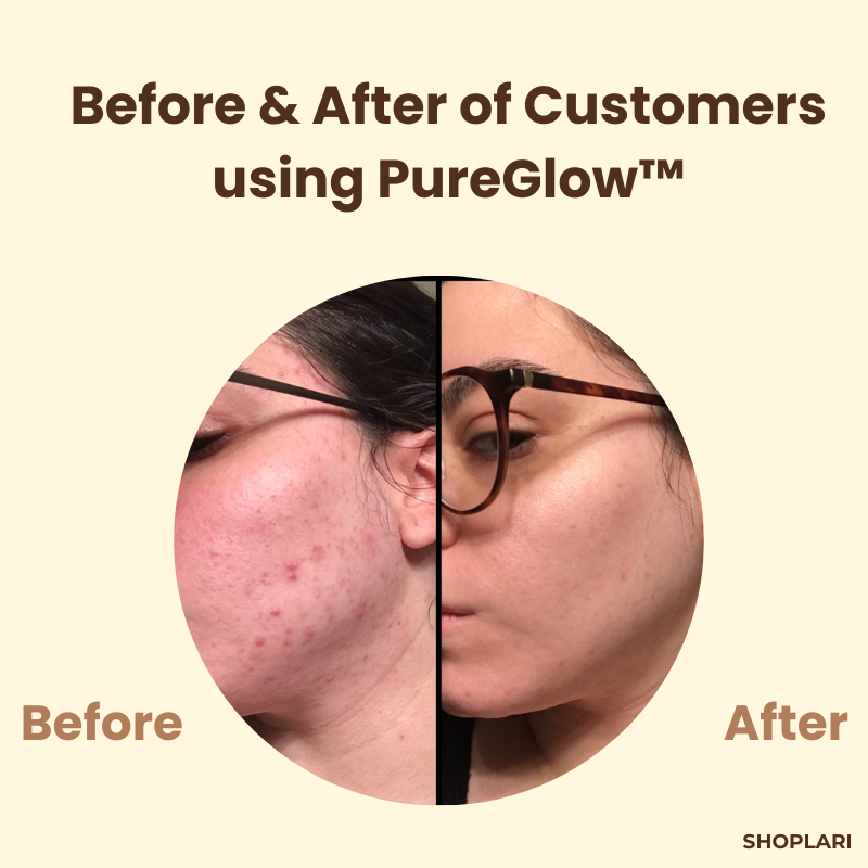 PureGlow™ – Klare, jugendliche Haut, die Selbstvertrauen ausstrahlt [1 + 1 Gratis]